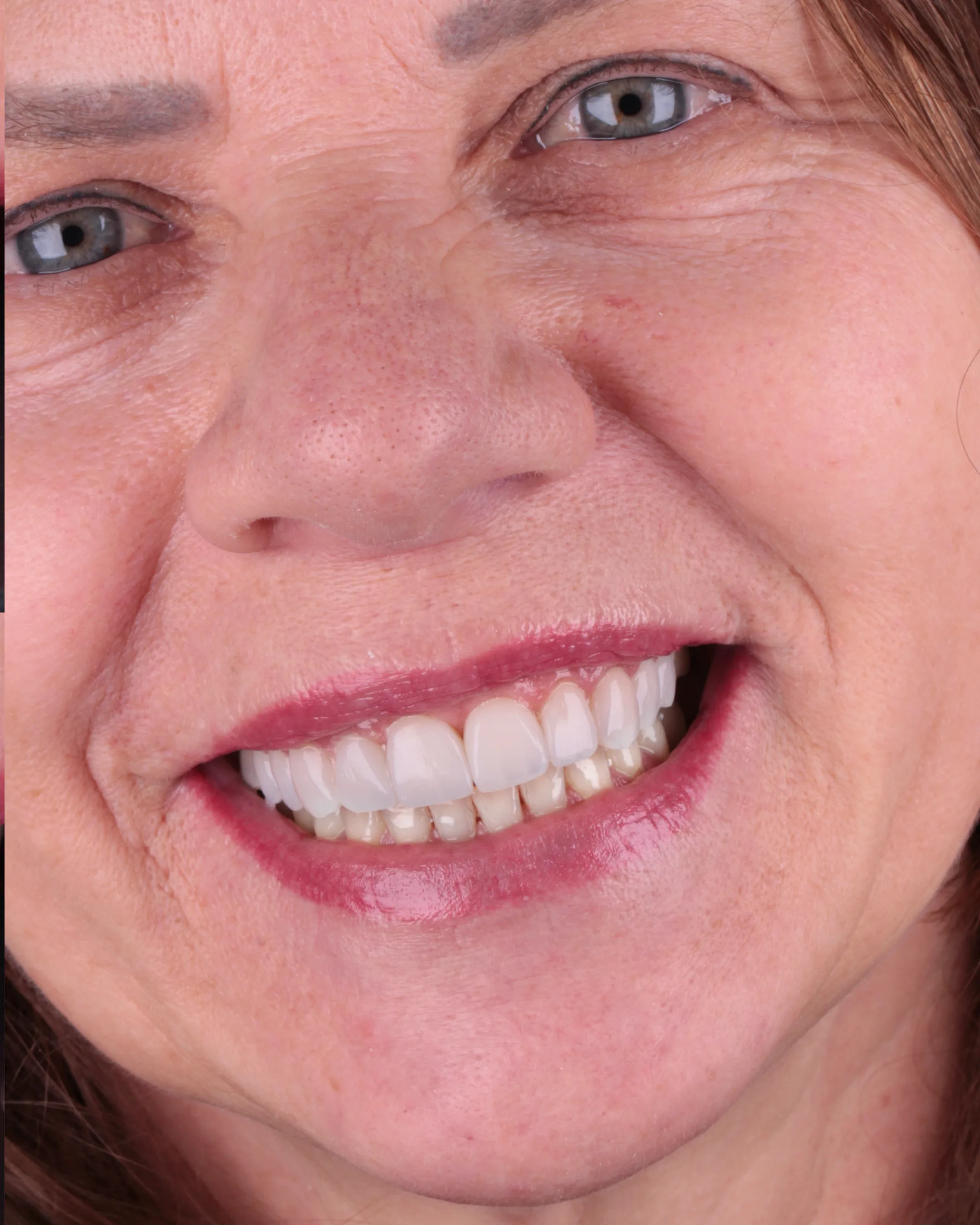 Sorriso natural após planejamento estético