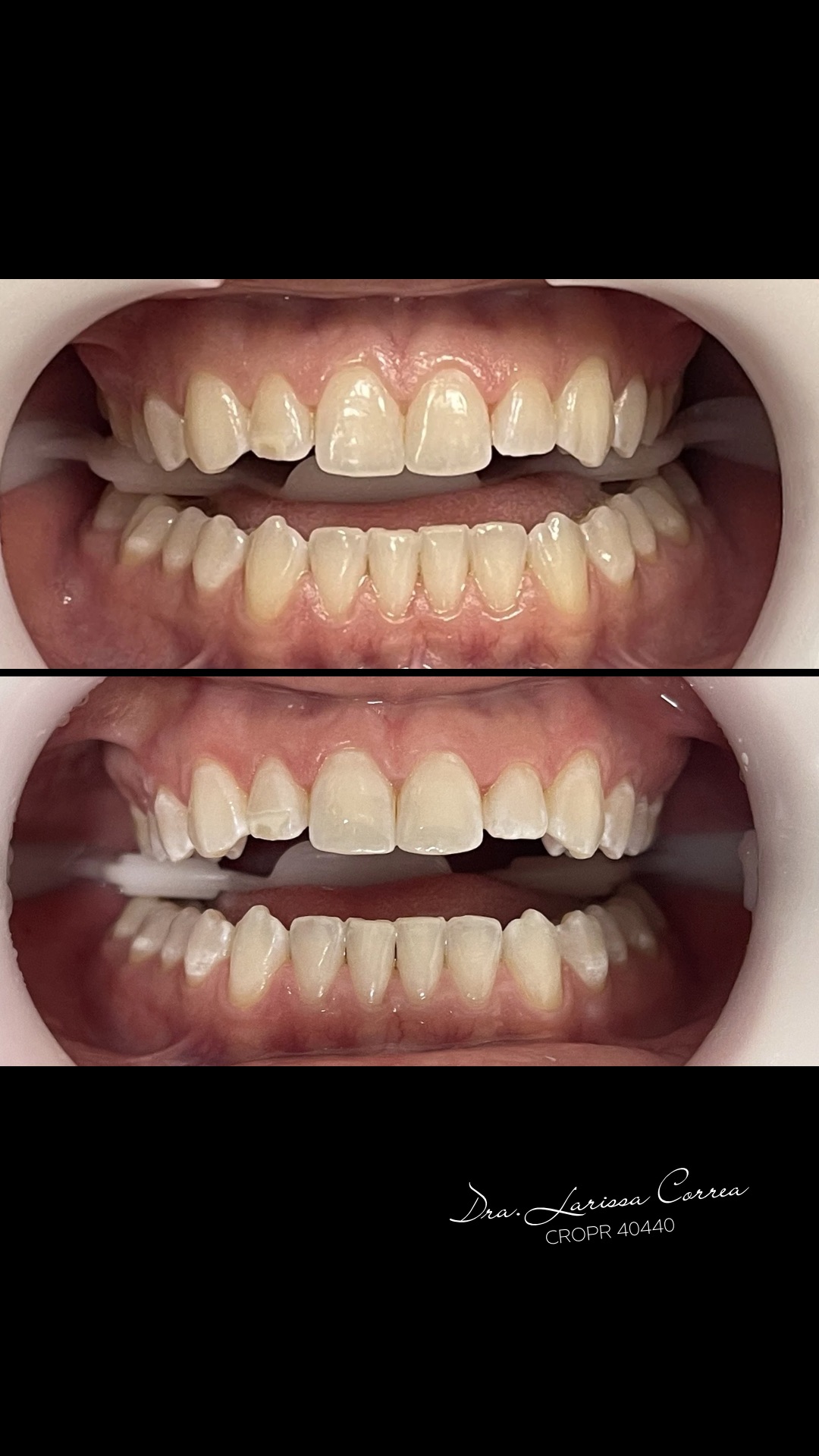 Registro clínico de clareamento dental em consultório