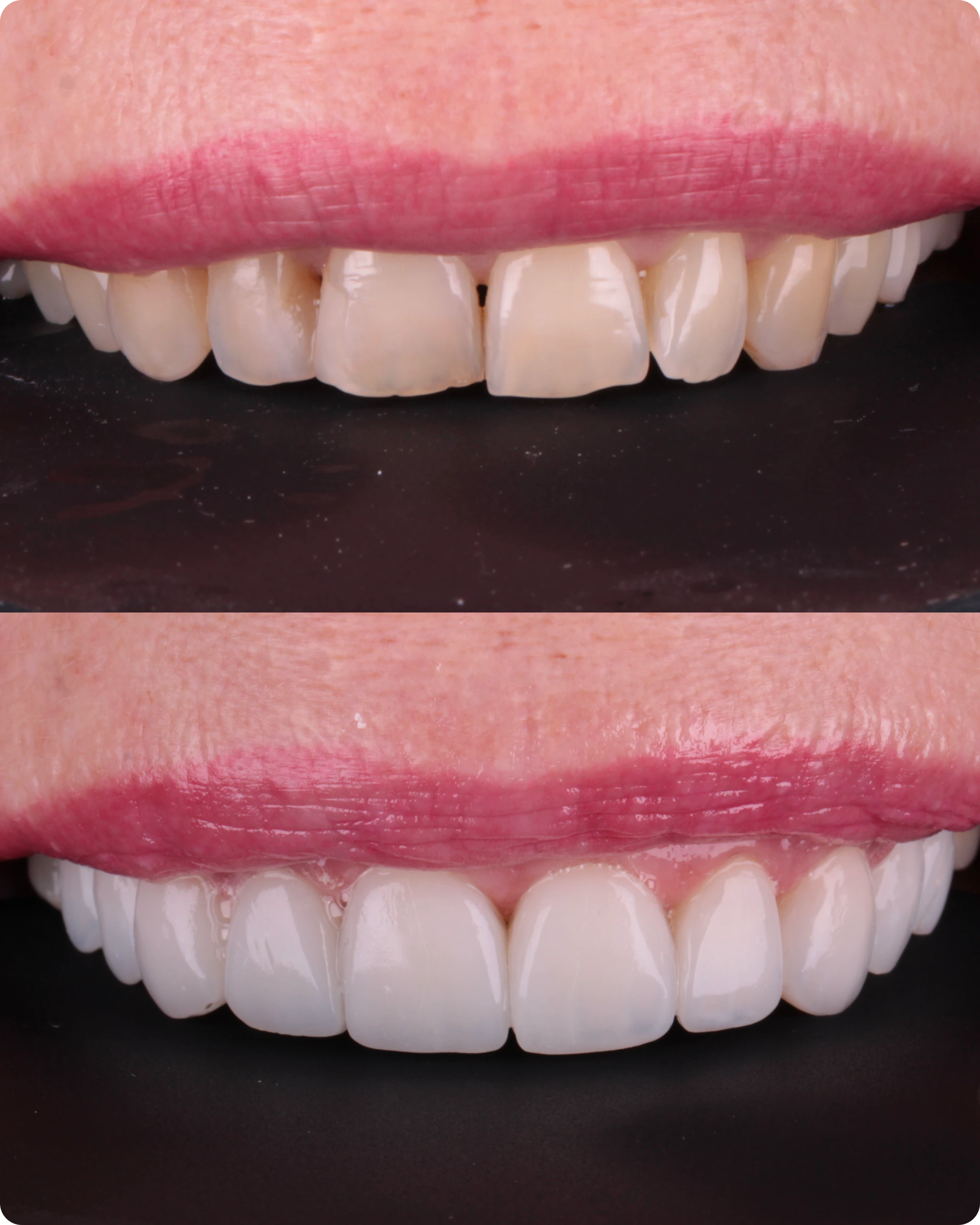 Antes e depois de facetas em resina